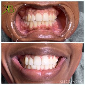 Teeth Whitening Services Winter Park Spa